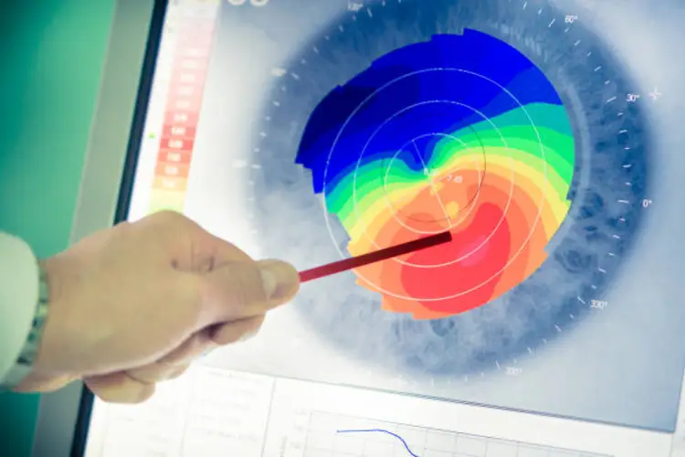 Keratoconus Treatment